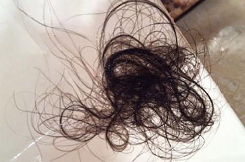 经常掉头发?皮肤科在线医生教你如何预防脱发