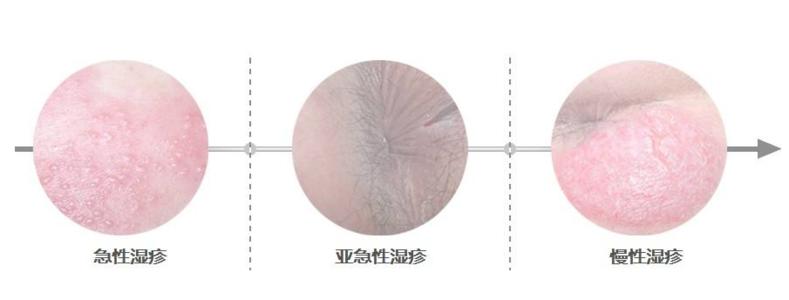 福州看湿疹的皮肤科医院哪家收费平价