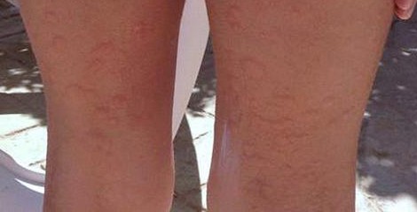 福州华研医院皮肤科:荨麻疹的治疗方法有哪些