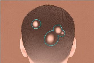 福州皮肤科:引起斑秃的原因是什么?怎么防治