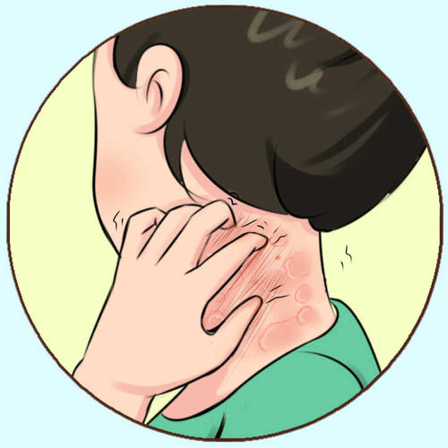 得了湿疹怎么办?福州皮肤科医院的五个建议